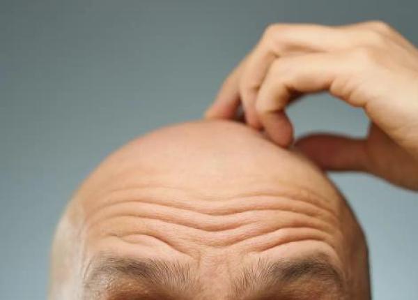 رشد دوبارهٔ مو با سلول های چربی؛ کشف تازه ای که می تواند طاسی را درمان کند