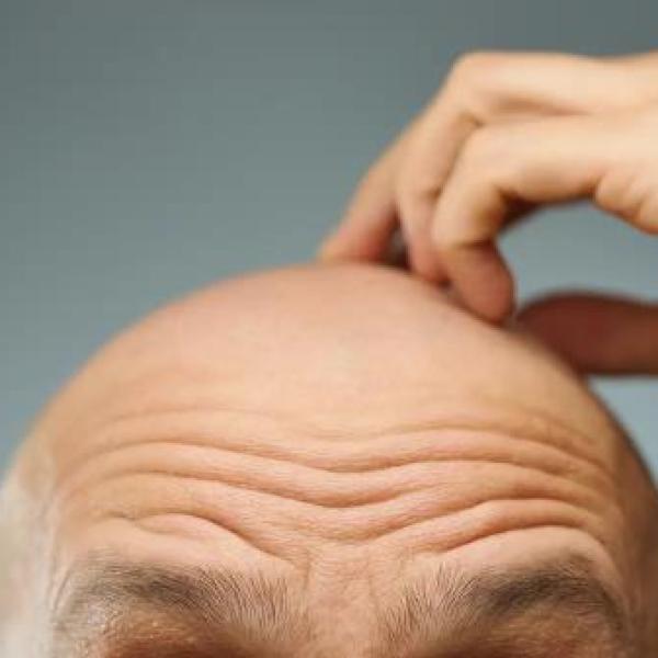 رشد دوبارهٔ مو با سلول های چربی؛ کشف تازه ای که می تواند طاسی را درمان کند